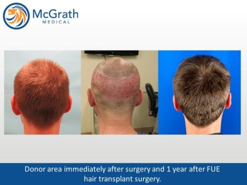 Follicular Unit Extraction FUE Hair Transplantation Neograft