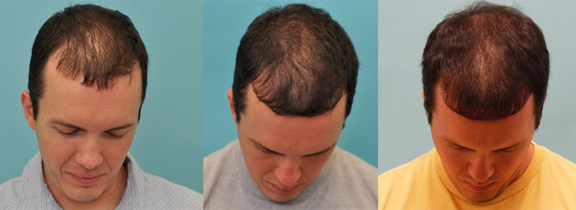 Hair Loss Solutions Dallas