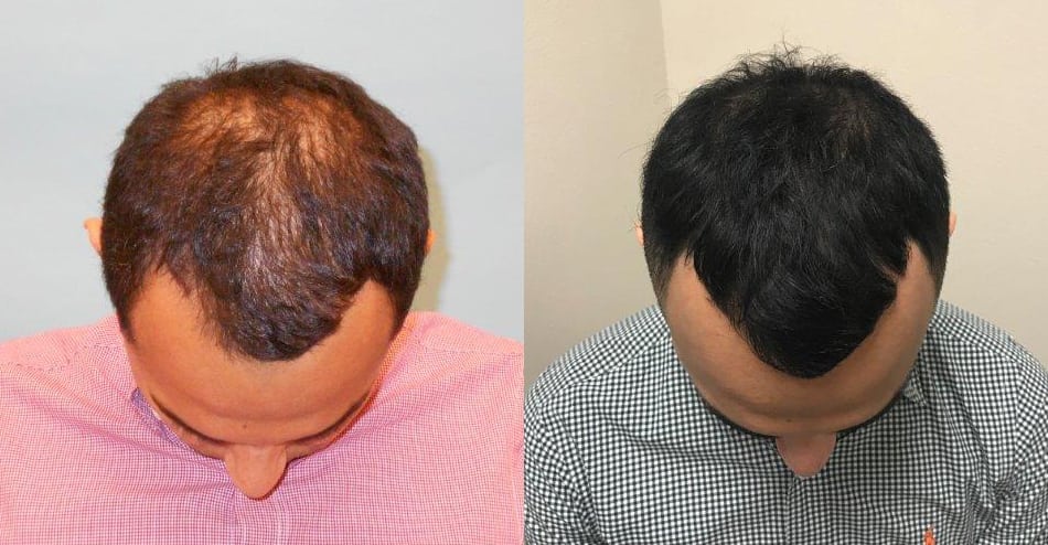 ACell + PRP Hair Loss Therapy Case Study - News - McGrath Medical