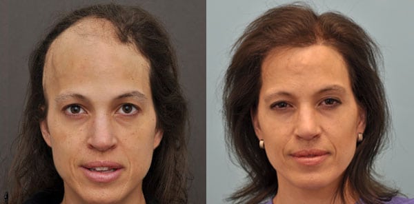 Cancer Patients Reconstructive Hair Transplant Update News 