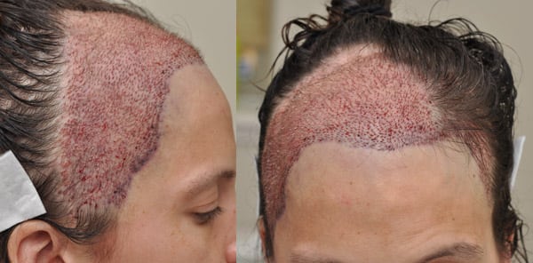 Cancer Patients Reconstructive Hair Transplant Update News 