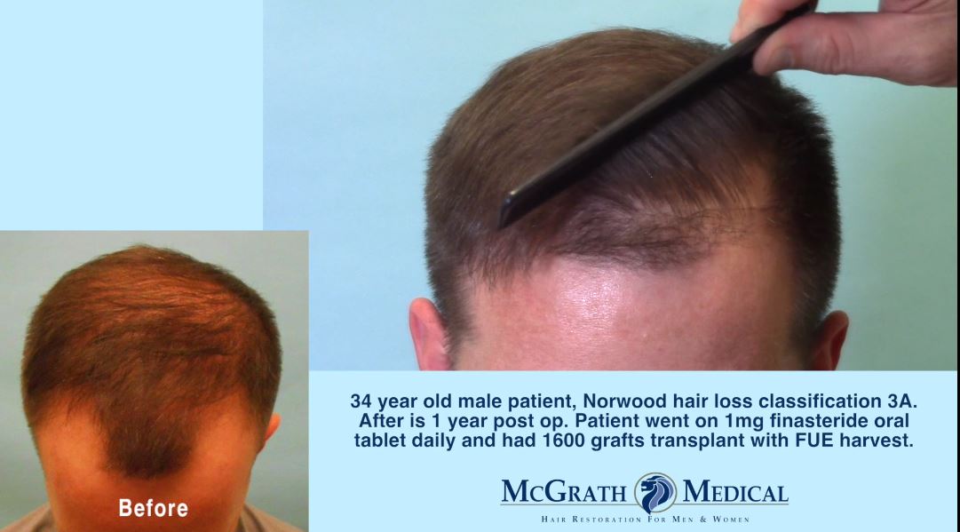 How natural can a hair transplant look? Take a close look! - Hair Transplant  Case Study - McGrath Medical