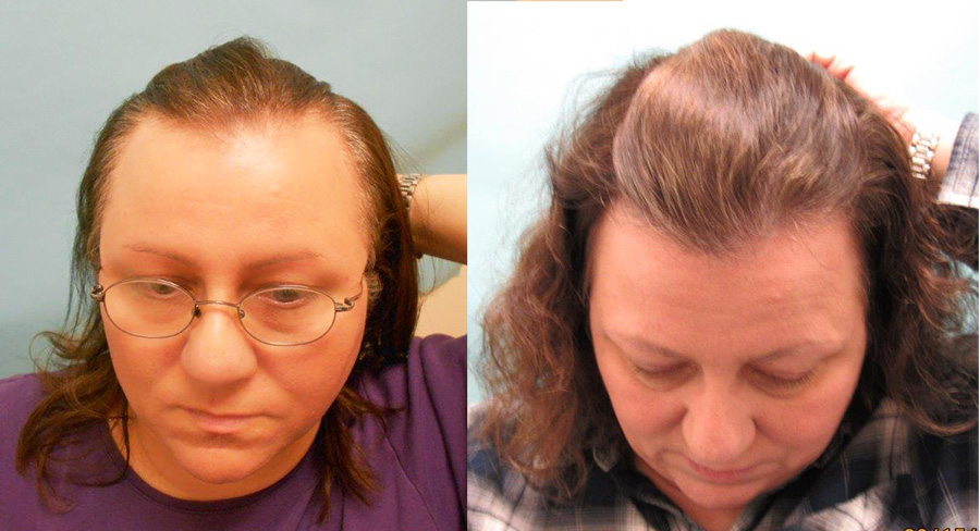 Female Hair Loss Treated with Oral Finasteride - Hair Transplant Case  Study, News - McGrath Medical