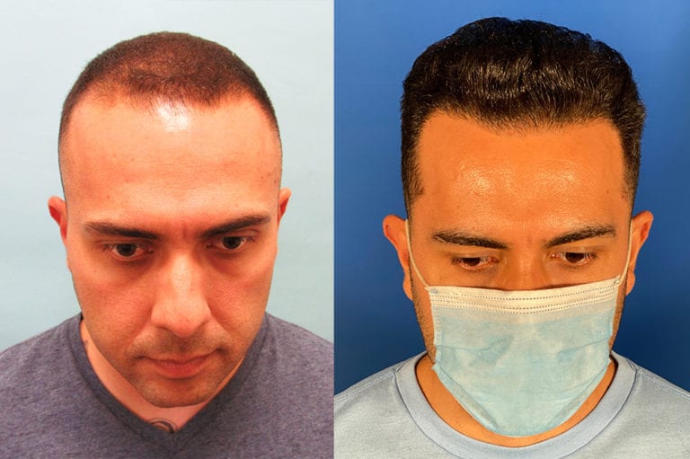 Combination Medical Therapy and Hair Transplant Surgery Hair