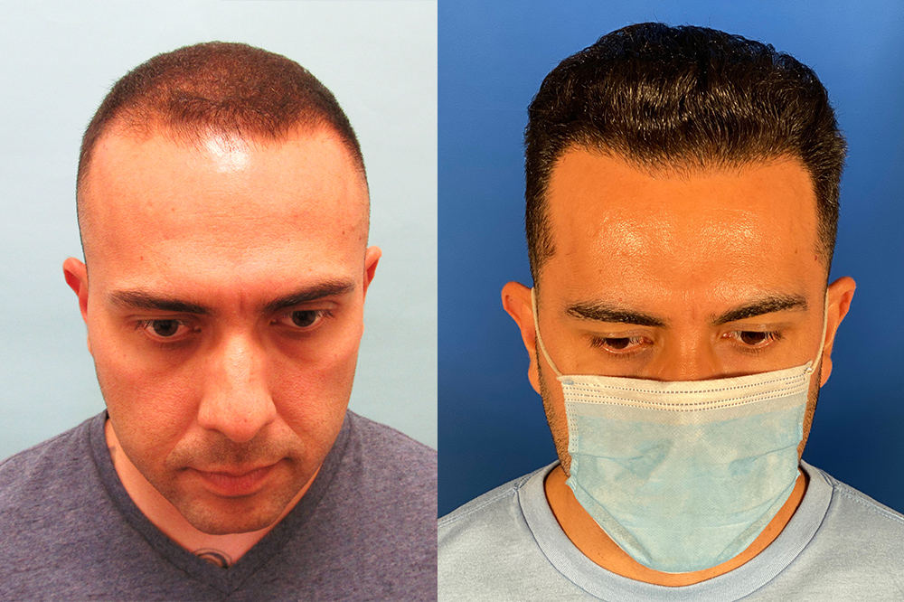 Combination Medical Therapy and Hair Transplant Surgery - Hair Transplant  Case Study - McGrath Medical