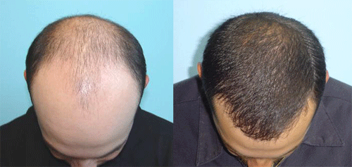 Hair Loss Expert, Austin, Texas (TX) Hair Loss Causes ...