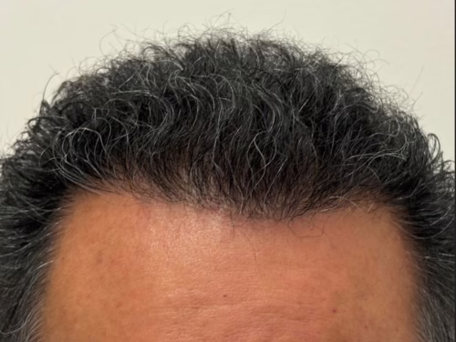 Hairline-MM