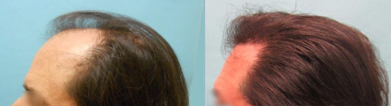 3000 Graft Hair Transplant Results - Hair Transplant Case Study ...