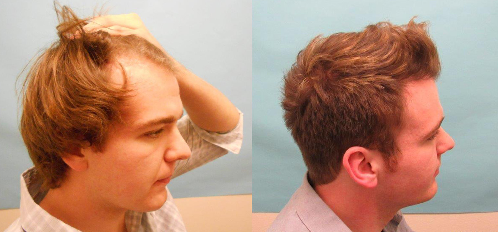 Video - Approach for Young Men Experiencing Hair Loss - Hair Transplant  Case Study - McGrath Medical