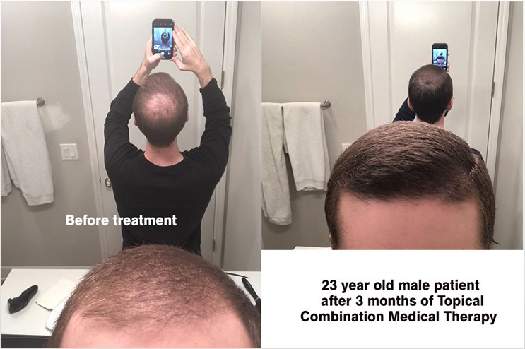 3 Month Medical Therapy Result - Hair Transplant Case Study - McGrath  Medical