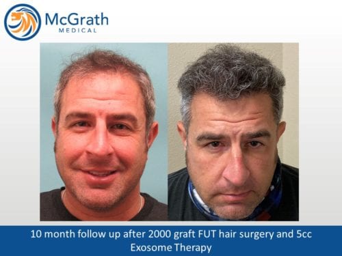 Before & After Hair Transplant Photos | McGrath Medical | Austin, TX Before & After Hair Transplant Photos | McGrath Medical | Austin, TX