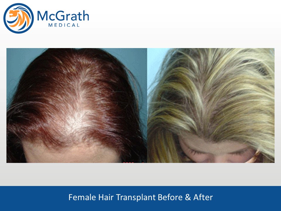 Female Hair Transplant Photos - Austin, Houston, Texas - McGrath Medical