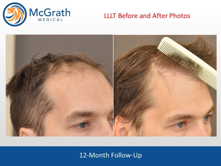 Capillus Laser Hair Therapy Austin, TX McGrath Medical