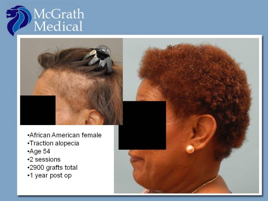 Traction Alopecia Hair Transplant in Austin TX