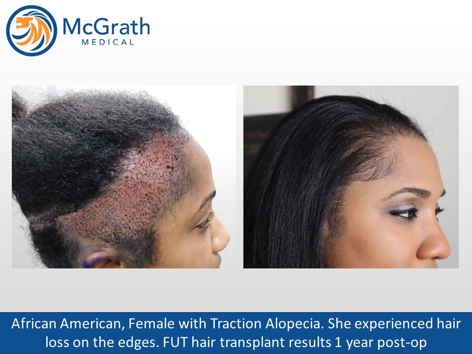 Traction Alopecia Hair Transplant in Austin TX