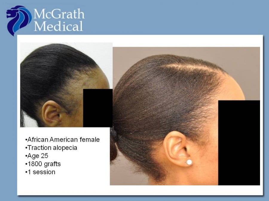 Traction Alopecia Hair Transplant in Austin TX