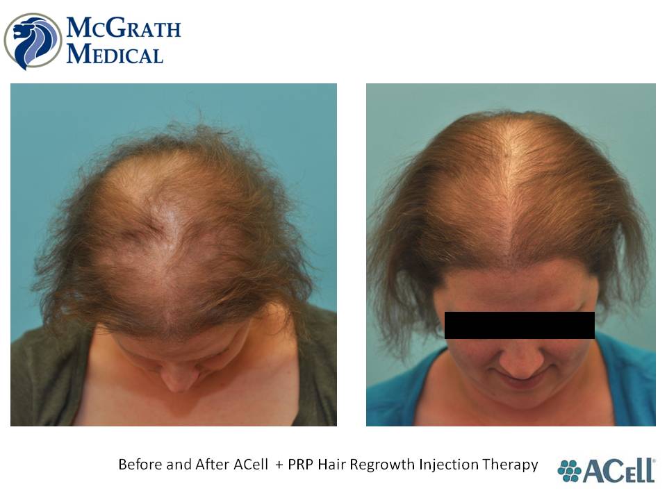 ACEll + PRP Hair Regrowth Injection Therapy | Austin, Houston & Dallas Texas