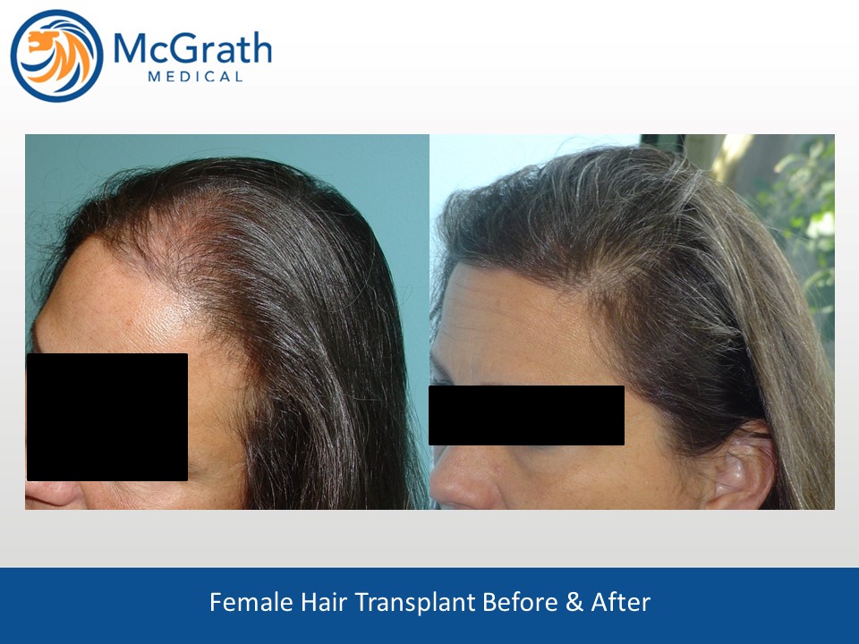 FUE Transplant Before & After