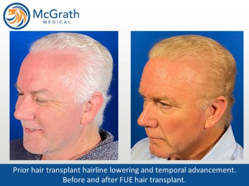Before & After Hair Transplant Photos | McGrath Medical | Austin, TX