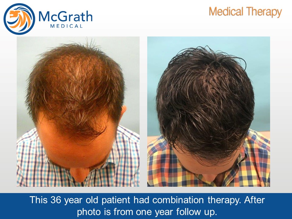 Combination Hair Loss Therapy - McGrath Medical Austin, Texas