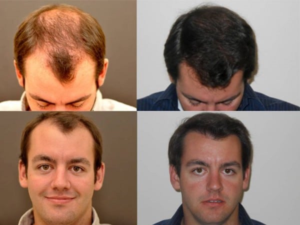 Hair Restoration Austin Houston And Dallas Tx Hair Transplantation