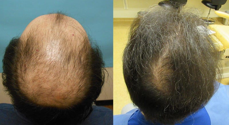 Case Study - Norwood Hair Loss Class V - Hair Transplant Case Study, News -  McGrath Medical