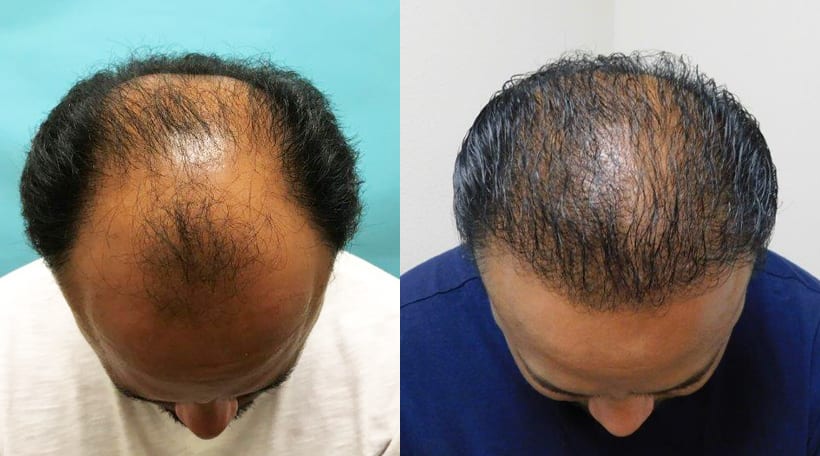 2900 Hair Graft - 4 Month Follow Up - Hair Transplant Case Study - McGrath  Medical