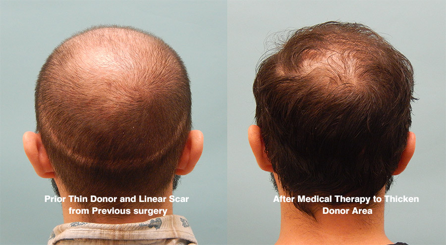 Surgical and Medical Case Study - Hair Transplant Case Study - McGrath  Medical